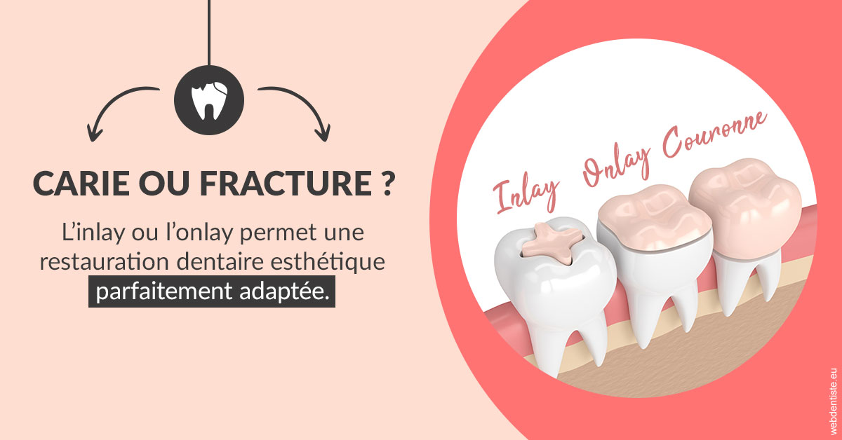 https://dr-petrakian-jean-marc.chirurgiens-dentistes.fr/T2 2023 - Carie ou fracture 2