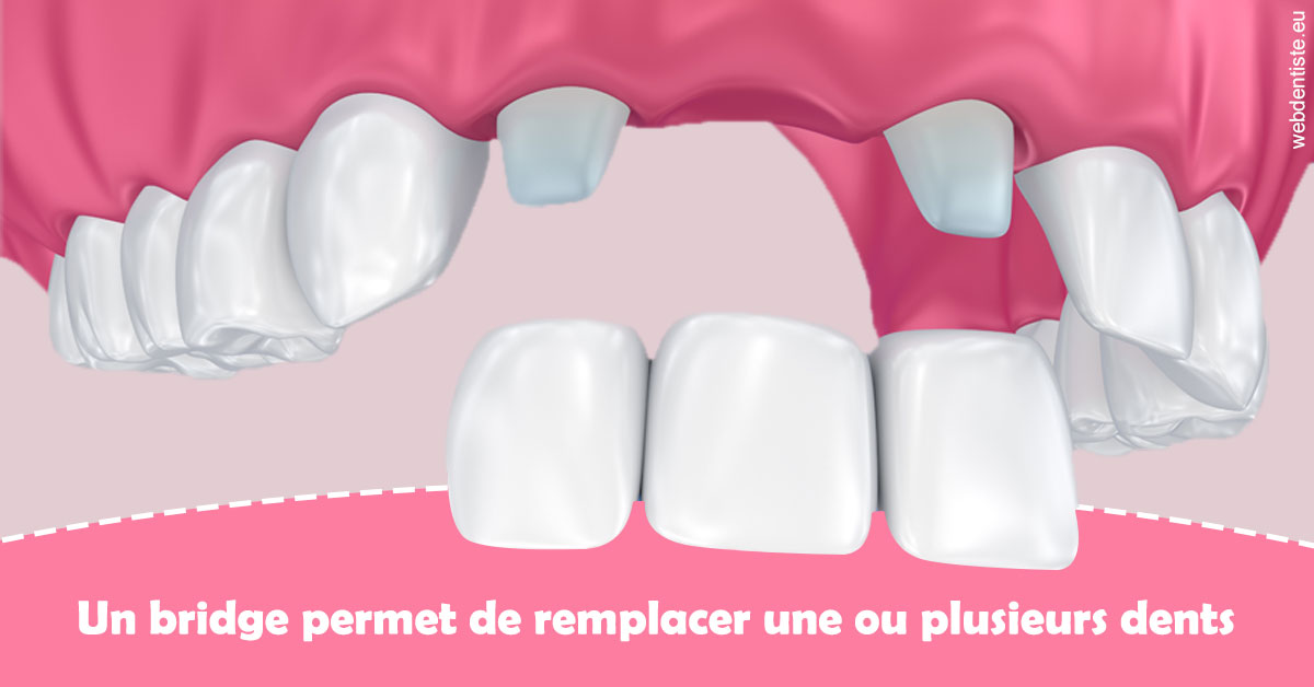 https://dr-petrakian-jean-marc.chirurgiens-dentistes.fr/Bridge remplacer dents 2