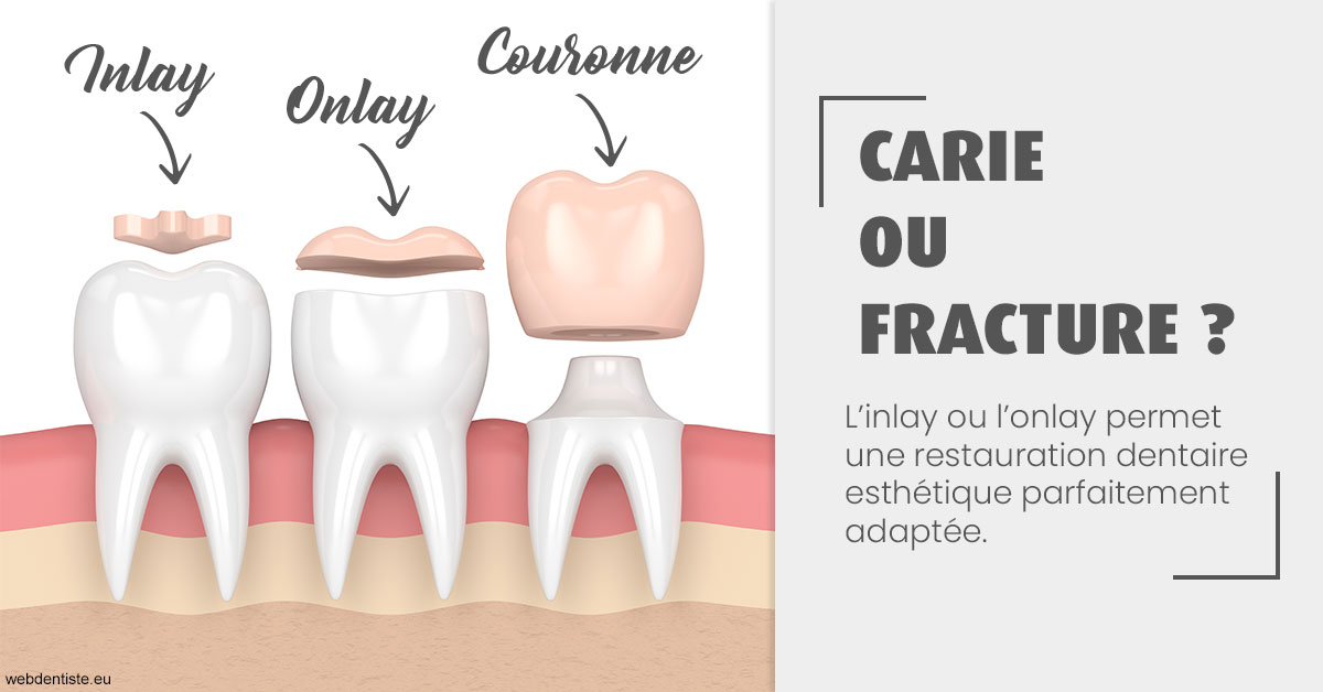 https://dr-petrakian-jean-marc.chirurgiens-dentistes.fr/T2 2023 - Carie ou fracture 1