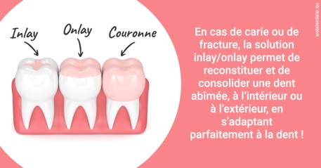 https://dr-petrakian-jean-marc.chirurgiens-dentistes.fr/L'INLAY ou l'ONLAY 2