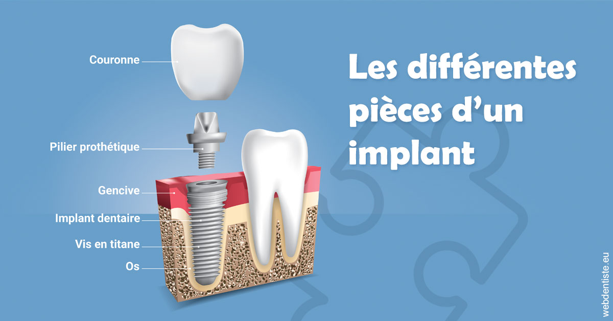 https://dr-petrakian-jean-marc.chirurgiens-dentistes.fr/Les différentes pièces d’un implant 1